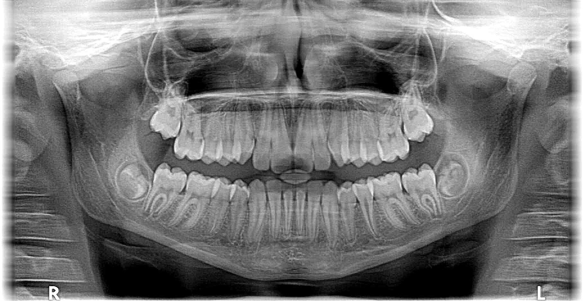 X-ray